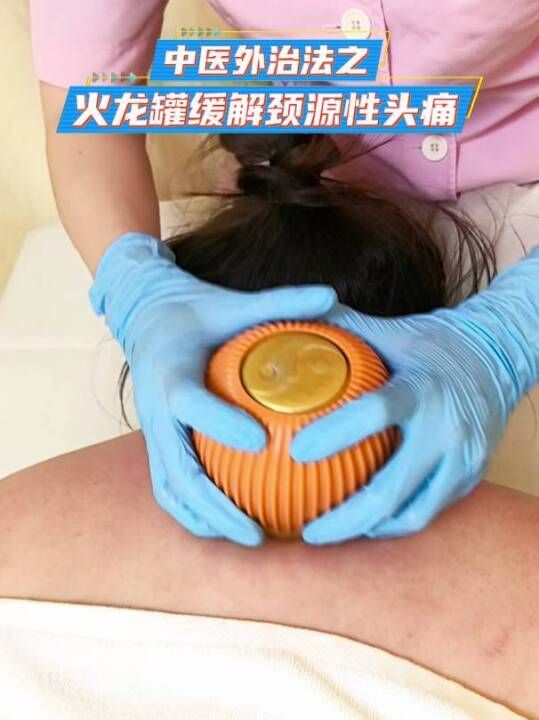 中医外治法之火龙罐缓解颈源性头痛